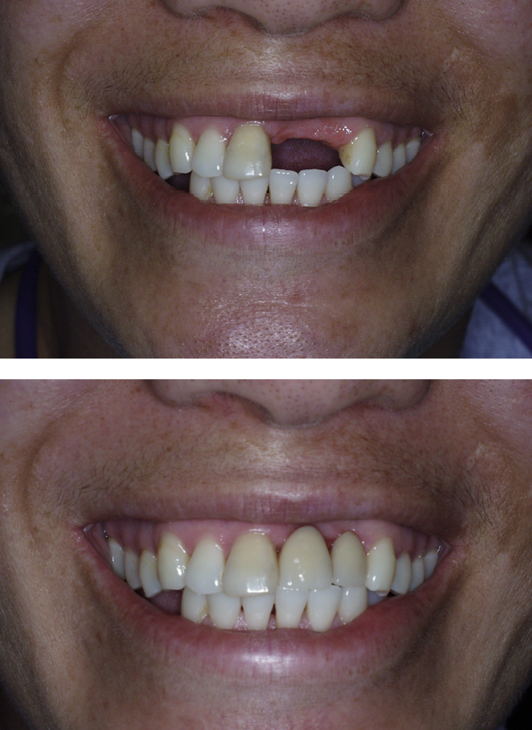 Before and after gum recession repair