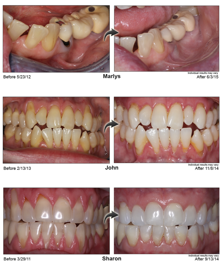 Before and After Pinhole Surgery Image 1