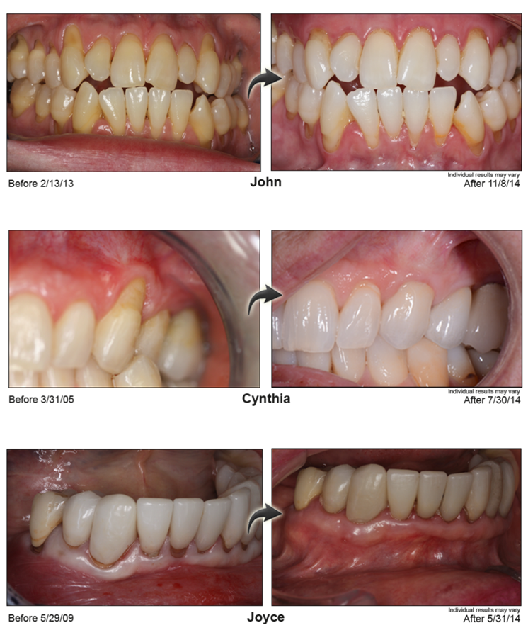 Before and After Pinhole Surgery Image 2