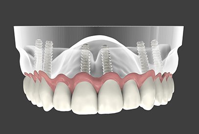 Implant supported dentures computer rendered photo