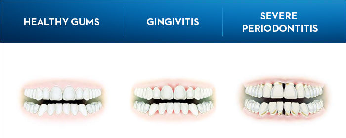 three signs of periodontitis